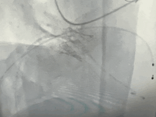 导丝怎么扩挑战高龄高危极限，引领微创“心”突破！大医二院赵昕教授团队使用Renatus®球扩瓣成功完成一例高难度经导管二尖瓣瓣中瓣置换术_https://www.jmylbn.com_新闻资讯_第11张