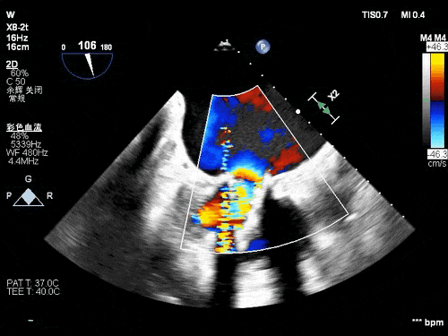 导丝怎么扩挑战高龄高危极限，引领微创“心”突破！大医二院赵昕教授团队使用Renatus®球扩瓣成功完成一例高难度经导管二尖瓣瓣中瓣置换术_https://www.jmylbn.com_新闻资讯_第7张