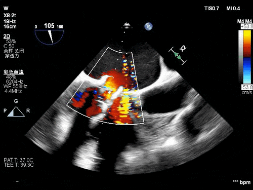 导丝怎么扩挑战高龄高危极限，引领微创“心”突破！大医二院赵昕教授团队使用Renatus®球扩瓣成功完成一例高难度经导管二尖瓣瓣中瓣置换术_https://www.jmylbn.com_新闻资讯_第12张