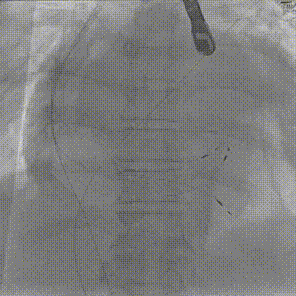 怎么上穿刺鞘攻克巨大左房伴转位穿刺难关！温医大附一院周浩教授团队创新应用“导丝定位+可调弯鞘”技术完成高难度TEER手术_https://www.jmylbn.com_新闻资讯_第14张