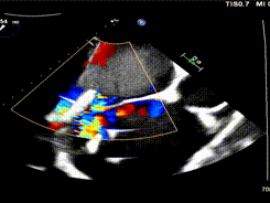 怎么上穿刺鞘攻克巨大左房伴转位穿刺难关！温医大附一院周浩教授团队创新应用“导丝定位+可调弯鞘”技术完成高难度TEER手术_https://www.jmylbn.com_新闻资讯_第42张