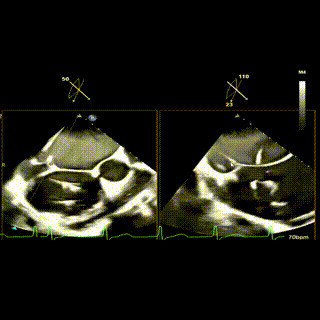 怎么上穿刺鞘攻克巨大左房伴转位穿刺难关！温医大附一院周浩教授团队创新应用“导丝定位+可调弯鞘”技术完成高难度TEER手术_https://www.jmylbn.com_新闻资讯_第21张