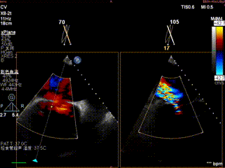 怎么上穿刺鞘攻克巨大左房伴转位穿刺难关！温医大附一院周浩教授团队创新应用“导丝定位+可调弯鞘”技术完成高难度TEER手术_https://www.jmylbn.com_新闻资讯_第7张