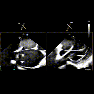 怎么上穿刺鞘攻克巨大左房伴转位穿刺难关！温医大附一院周浩教授团队创新应用“导丝定位+可调弯鞘”技术完成高难度TEER手术_https://www.jmylbn.com_新闻资讯_第24张