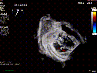 怎么上穿刺鞘攻克巨大左房伴转位穿刺难关！温医大附一院周浩教授团队创新应用“导丝定位+可调弯鞘”技术完成高难度TEER手术_https://www.jmylbn.com_新闻资讯_第9张