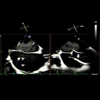 怎么上穿刺鞘攻克巨大左房伴转位穿刺难关！温医大附一院周浩教授团队创新应用“导丝定位+可调弯鞘”技术完成高难度TEER手术_https://www.jmylbn.com_新闻资讯_第17张