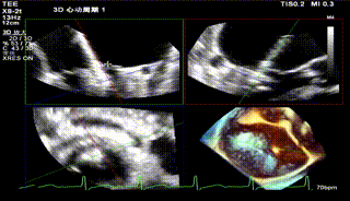 怎么上穿刺鞘攻克巨大左房伴转位穿刺难关！温医大附一院周浩教授团队创新应用“导丝定位+可调弯鞘”技术完成高难度TEER手术_https://www.jmylbn.com_新闻资讯_第33张