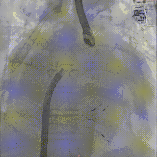 怎么上穿刺鞘攻克巨大左房伴转位穿刺难关！温医大附一院周浩教授团队创新应用“导丝定位+可调弯鞘”技术完成高难度TEER手术_https://www.jmylbn.com_新闻资讯_第25张