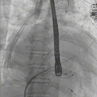怎么上穿刺鞘攻克巨大左房伴转位穿刺难关！温医大附一院周浩教授团队创新应用“导丝定位+可调弯鞘”技术完成高难度TEER手术_https://www.jmylbn.com_新闻资讯_第18张