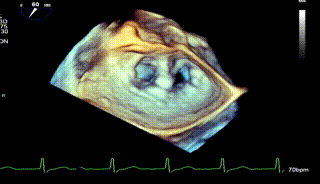 怎么上穿刺鞘攻克巨大左房伴转位穿刺难关！温医大附一院周浩教授团队创新应用“导丝定位+可调弯鞘”技术完成高难度TEER手术_https://www.jmylbn.com_新闻资讯_第30张