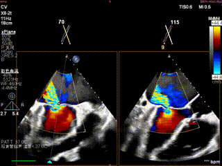 怎么上穿刺鞘攻克巨大左房伴转位穿刺难关！温医大附一院周浩教授团队创新应用“导丝定位+可调弯鞘”技术完成高难度TEER手术_https://www.jmylbn.com_新闻资讯_第5张