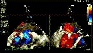 怎么上穿刺鞘攻克巨大左房伴转位穿刺难关！温医大附一院周浩教授团队创新应用“导丝定位+可调弯鞘”技术完成高难度TEER手术_https://www.jmylbn.com_新闻资讯_第34张