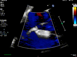 怎么上穿刺鞘攻克巨大左房伴转位穿刺难关！温医大附一院周浩教授团队创新应用“导丝定位+可调弯鞘”技术完成高难度TEER手术_https://www.jmylbn.com_新闻资讯_第47张