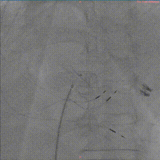 怎么上穿刺鞘攻克巨大左房伴转位穿刺难关！温医大附一院周浩教授团队创新应用“导丝定位+可调弯鞘”技术完成高难度TEER手术_https://www.jmylbn.com_新闻资讯_第44张