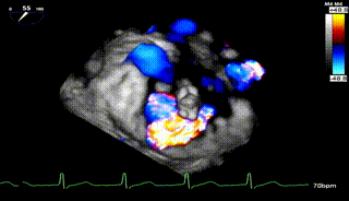 怎么上穿刺鞘攻克巨大左房伴转位穿刺难关！温医大附一院周浩教授团队创新应用“导丝定位+可调弯鞘”技术完成高难度TEER手术_https://www.jmylbn.com_新闻资讯_第26张