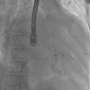 怎么上穿刺鞘攻克巨大左房伴转位穿刺难关！温医大附一院周浩教授团队创新应用“导丝定位+可调弯鞘”技术完成高难度TEER手术_https://www.jmylbn.com_新闻资讯_第16张