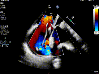 怎么上穿刺鞘攻克巨大左房伴转位穿刺难关！温医大附一院周浩教授团队创新应用“导丝定位+可调弯鞘”技术完成高难度TEER手术_https://www.jmylbn.com_新闻资讯_第46张