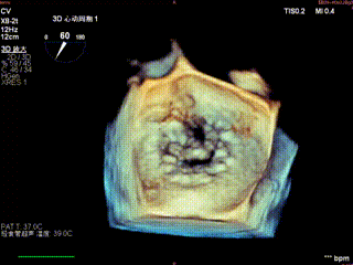怎么上穿刺鞘攻克巨大左房伴转位穿刺难关！温医大附一院周浩教授团队创新应用“导丝定位+可调弯鞘”技术完成高难度TEER手术_https://www.jmylbn.com_新闻资讯_第8张