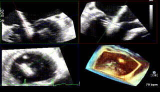 怎么上穿刺鞘攻克巨大左房伴转位穿刺难关！温医大附一院周浩教授团队创新应用“导丝定位+可调弯鞘”技术完成高难度TEER手术_https://www.jmylbn.com_新闻资讯_第27张