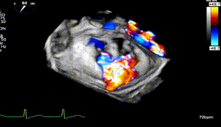 怎么上穿刺鞘攻克巨大左房伴转位穿刺难关！温医大附一院周浩教授团队创新应用“导丝定位+可调弯鞘”技术完成高难度TEER手术_https://www.jmylbn.com_新闻资讯_第31张
