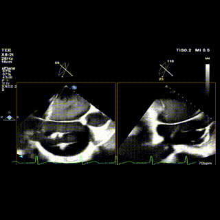 怎么上穿刺鞘攻克巨大左房伴转位穿刺难关！温医大附一院周浩教授团队创新应用“导丝定位+可调弯鞘”技术完成高难度TEER手术_https://www.jmylbn.com_新闻资讯_第23张
