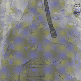 怎么上穿刺鞘攻克巨大左房伴转位穿刺难关！温医大附一院周浩教授团队创新应用“导丝定位+可调弯鞘”技术完成高难度TEER手术_https://www.jmylbn.com_新闻资讯_第20张