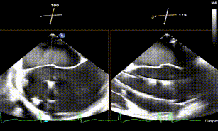 怎么上穿刺鞘攻克巨大左房伴转位穿刺难关！温医大附一院周浩教授团队创新应用“导丝定位+可调弯鞘”技术完成高难度TEER手术_https://www.jmylbn.com_新闻资讯_第12张