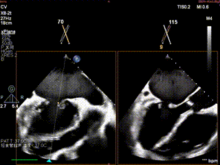 怎么上穿刺鞘攻克巨大左房伴转位穿刺难关！温医大附一院周浩教授团队创新应用“导丝定位+可调弯鞘”技术完成高难度TEER手术_https://www.jmylbn.com_新闻资讯_第4张