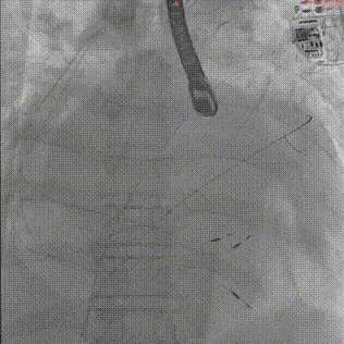 怎么上穿刺鞘攻克巨大左房伴转位穿刺难关！温医大附一院周浩教授团队创新应用“导丝定位+可调弯鞘”技术完成高难度TEER手术_https://www.jmylbn.com_新闻资讯_第22张