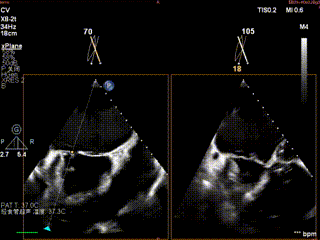 怎么上穿刺鞘攻克巨大左房伴转位穿刺难关！温医大附一院周浩教授团队创新应用“导丝定位+可调弯鞘”技术完成高难度TEER手术_https://www.jmylbn.com_新闻资讯_第6张