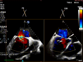 怎么上穿刺鞘攻克巨大左房伴转位穿刺难关！温医大附一院周浩教授团队创新应用“导丝定位+可调弯鞘”技术完成高难度TEER手术_https://www.jmylbn.com_新闻资讯_第3张