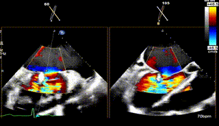 怎么上穿刺鞘攻克巨大左房伴转位穿刺难关！温医大附一院周浩教授团队创新应用“导丝定位+可调弯鞘”技术完成高难度TEER手术_https://www.jmylbn.com_新闻资讯_第29张
