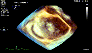 怎么上穿刺鞘攻克巨大左房伴转位穿刺难关！温医大附一院周浩教授团队创新应用“导丝定位+可调弯鞘”技术完成高难度TEER手术_https://www.jmylbn.com_新闻资讯_第35张