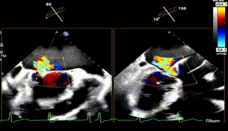 怎么上穿刺鞘攻克巨大左房伴转位穿刺难关！温医大附一院周浩教授团队创新应用“导丝定位+可调弯鞘”技术完成高难度TEER手术_https://www.jmylbn.com_新闻资讯_第28张