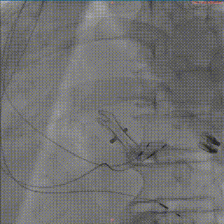 怎么上穿刺鞘攻克巨大左房伴转位穿刺难关！温医大附一院周浩教授团队创新应用“导丝定位+可调弯鞘”技术完成高难度TEER手术_https://www.jmylbn.com_新闻资讯_第45张