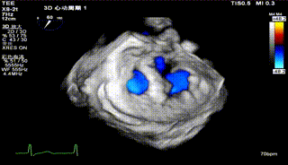 怎么上穿刺鞘攻克巨大左房伴转位穿刺难关！温医大附一院周浩教授团队创新应用“导丝定位+可调弯鞘”技术完成高难度TEER手术_https://www.jmylbn.com_新闻资讯_第36张