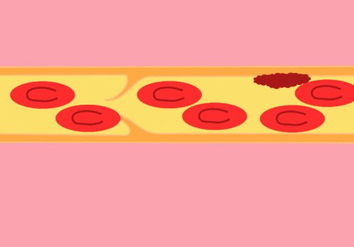 有了血栓怎么办？专家告诉您：补肽很重要！