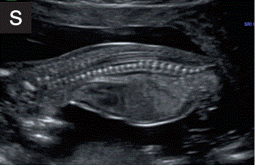 胎儿mt是什么检查什么疼吗【文献学习／规范指南】ISUOG实践指南（2023更新）： 11-14周胎儿超声检查（全文）_https://www.jmylbn.com_新闻资讯_第26张