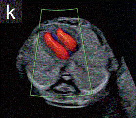 胎儿mt是什么检查什么疼吗【文献学习／规范指南】ISUOG实践指南（2023更新）： 11-14周胎儿超声检查（全文）_https://www.jmylbn.com_新闻资讯_第18张
