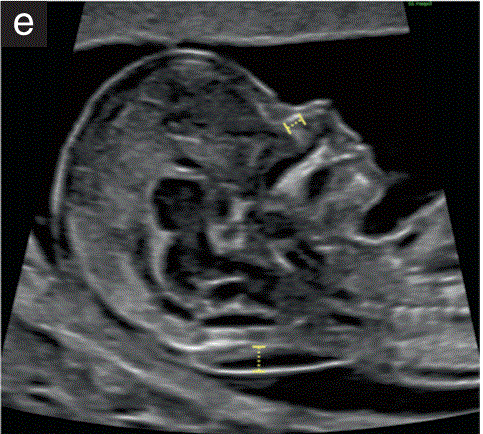 胎儿mt是什么检查什么疼吗【文献学习／规范指南】ISUOG实践指南（2023更新）： 11-14周胎儿超声检查（全文）_https://www.jmylbn.com_新闻资讯_第16张