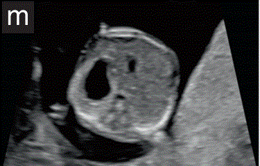 胎儿mt是什么检查什么疼吗【文献学习／规范指南】ISUOG实践指南（2023更新）： 11-14周胎儿超声检查（全文）_https://www.jmylbn.com_新闻资讯_第20张