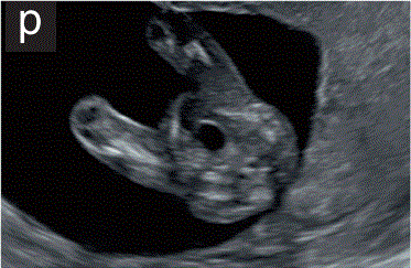 胎儿mt是什么检查什么疼吗【文献学习／规范指南】ISUOG实践指南（2023更新）： 11-14周胎儿超声检查（全文）_https://www.jmylbn.com_新闻资讯_第22张