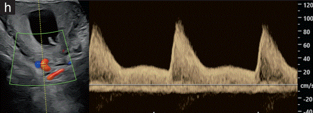 胎儿mt是什么检查什么疼吗【文献学习／规范指南】ISUOG实践指南（2023更新）： 11-14周胎儿超声检查（全文）_https://www.jmylbn.com_新闻资讯_第35张