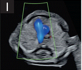 胎儿mt是什么检查什么疼吗【文献学习／规范指南】ISUOG实践指南（2023更新）： 11-14周胎儿超声检查（全文）_https://www.jmylbn.com_新闻资讯_第19张