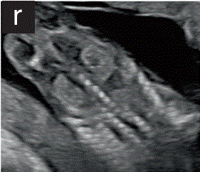 胎儿mt是什么检查什么疼吗【文献学习／规范指南】ISUOG实践指南（2023更新）： 11-14周胎儿超声检查（全文）_https://www.jmylbn.com_新闻资讯_第21张