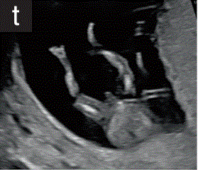 胎儿mt是什么检查什么疼吗【文献学习／规范指南】ISUOG实践指南（2023更新）： 11-14周胎儿超声检查（全文）_https://www.jmylbn.com_新闻资讯_第27张