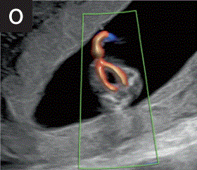 胎儿mt是什么检查什么疼吗【文献学习／规范指南】ISUOG实践指南（2023更新）： 11-14周胎儿超声检查（全文）_https://www.jmylbn.com_新闻资讯_第25张