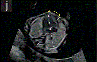 胎儿mt是什么检查什么疼吗【文献学习／规范指南】ISUOG实践指南（2023更新）： 11-14周胎儿超声检查（全文）_https://www.jmylbn.com_新闻资讯_第17张
