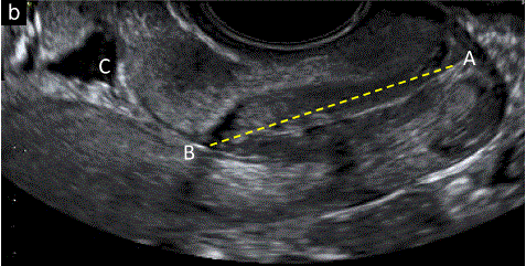 胎儿mt是什么检查什么疼吗【文献学习／规范指南】ISUOG实践指南（2023更新）： 11-14周胎儿超声检查（全文）_https://www.jmylbn.com_新闻资讯_第34张