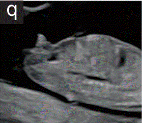 胎儿mt是什么检查什么疼吗【文献学习／规范指南】ISUOG实践指南（2023更新）： 11-14周胎儿超声检查（全文）_https://www.jmylbn.com_新闻资讯_第23张